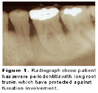 Chronic Periodontitis  2473