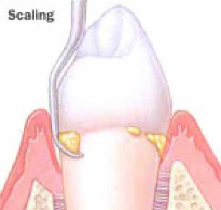 Chronic Periodontitis  2475