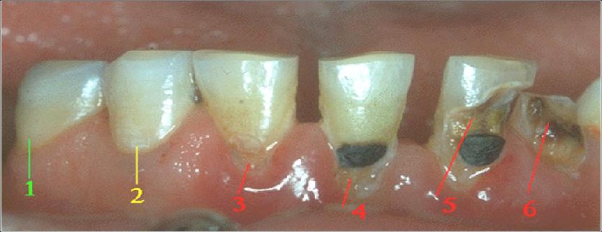 ما هو تسوس الأسنان؟ What is Dental Caries?  727