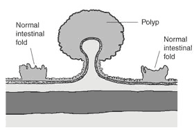 موسوعة أمراض القولون والمستقيم والشرج Polyp2