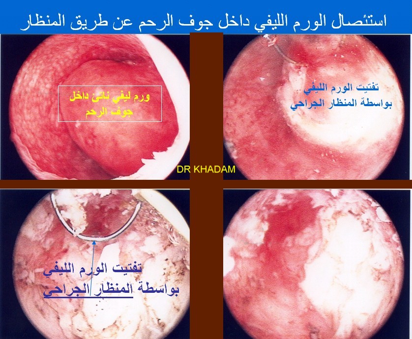 ألياف الرّحم.. وطرق علاجها FIBROME%20HYSTERO