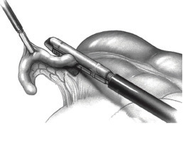 التهاب الزائدة الدودية Appendicitis: جراحة المنظار 2097_3