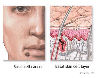 سرطان الخلية القاعدية Basal Cell Carcinoma Basal-Cell-Carcinoma