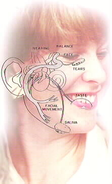 الشلل الوجهي  Bell_Palsy_4