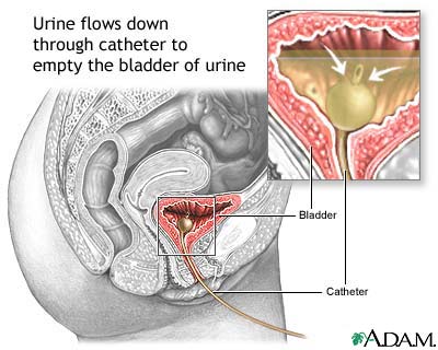 الانسداد البولي  Bladder_catheterization_female