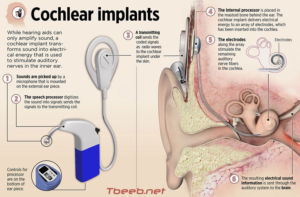 سماعات الأذن الطبية لضعف السمع  COCHLEAR-IMPLANT
