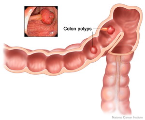 سرطان القولون Colon_Cancer