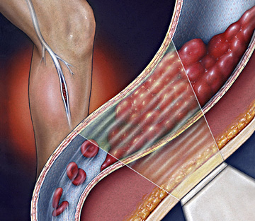 التخثر الوريدي العميق Deep vein thrombosis Deep_vein_thrombosis