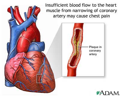 الكوليسترول المرتفع Elevated Cholesterol Elevated_Cholesterol