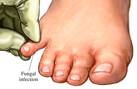 التينيا/السعفة...tenia Fungal-infection