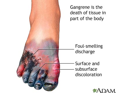 غرغرينة -  موت عضوي Gangrene  Gangrene