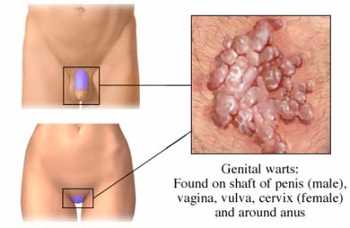  الثاليل التناسلية ، التواليل التناسليه Genital warts  Genital_warts