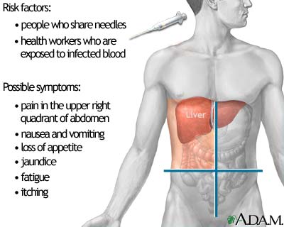 التهاب الكبد الحاد والمزمن Hepatitis-C