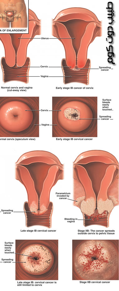 سرطان عنق الرحم                     علي Human_Papilloma_Virus-HPV