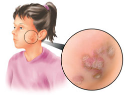 الحصف ، القوباء Impetigo Impetigo