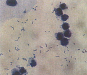 الاختبارات الميكروسكوبية  Microscopic Tests Infected_Urine