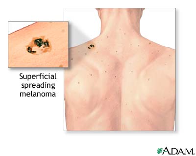 ‏الميلانوما ، سرطان الخلايا الصبغية Melanoma Melanoma