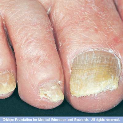 فطريات الأظافر، الالتهابات الفطرية في أظافر اليدين والقدمين Nail fungus Nail-fungus