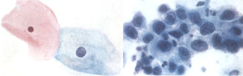 الاختبارات الميكروسكوبية  Microscopic Tests Normal_%26_Abnormal_Cervical_Cells