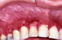 فقاقيع الفم  Pemphigoid