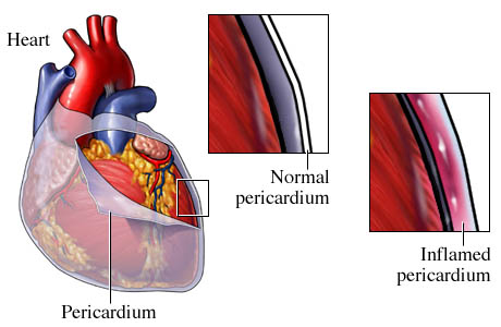 التهاب التامور ، التهاب غلاف القلب Pericarditis_1