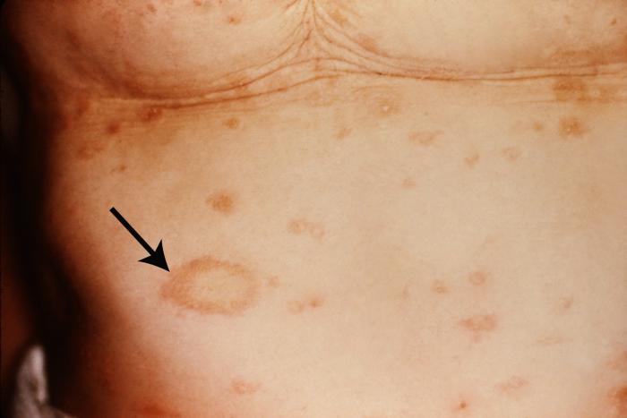 النخالية الوردية Pityriasis Rosea Pityriasis-Rosea