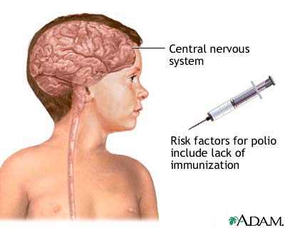 شلل الاطفال ماهو ومااعراضه Poliomyelitis