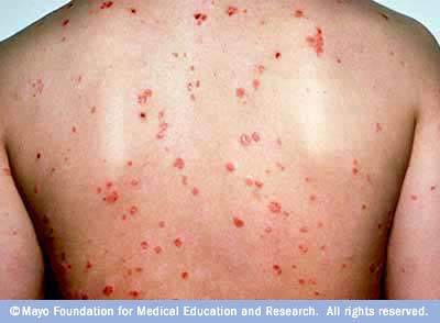 تصلب الجلد Scleroderma  Psoriasis