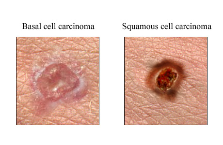 سرطان الخلية الحرشفية Squamous Cell Carcinoma Squamous-Cell-Carcinoma