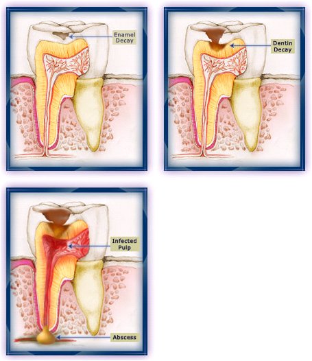 تسوس الاسنان Tooth-Decay