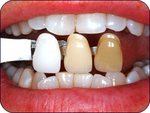 الأسنان التي تغير لونها  Tooth_whitening_bleaching_brightening