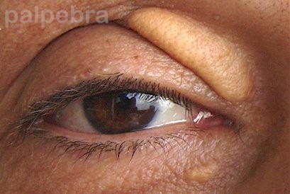 موسوعة أمراض العيون Xanthelasma