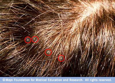 ‏القمل Lice Head-lice