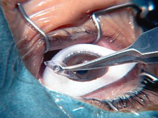 الليزك ( ليزر تصحيح الابصار ) سؤال وجواب ؟؟ Lasik