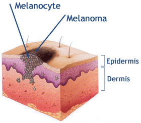 ‏الميلانوما ، سرطان الخلايا الصبغية Melanoma Melanocyte