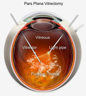 موسوعة متكامله عن امراض العين Pars_plana_vitrectomy