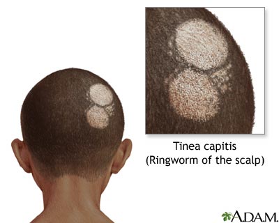 التينيا/السعفة...tenia Ringworm-of-the-scalp