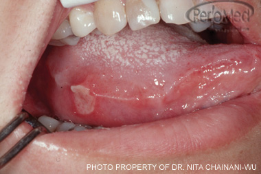 قرح الفم و الشفاه . Ulcer_mouth