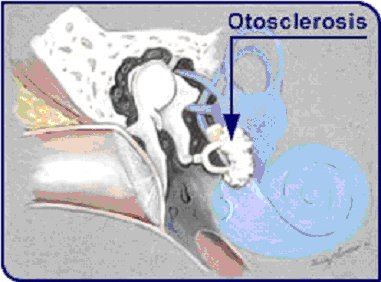 التصلب الأذني Otos