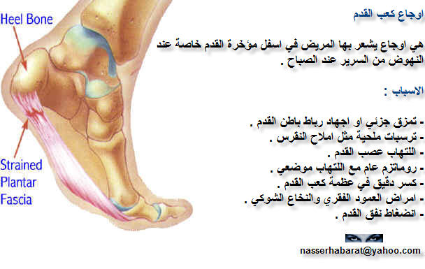 شوكة الكعب Plantar_fasciitis1