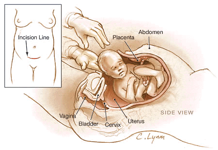 الولادة القيصرية  Cesarean delivery 136f8e578f