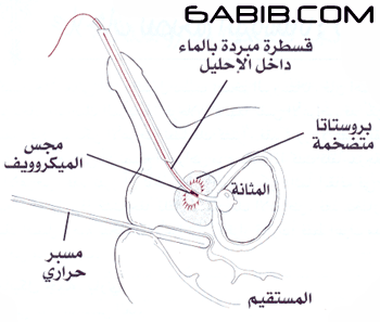 تضخم البروستاتا ، تضخم غدة البروستات Enlarged Prostate BPH 1500feda5f