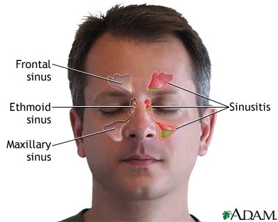 التهاب الجيوب الأنفية sinusitis 1a7acb731e