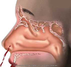 الرعاف – نزيف الانف Nosebleeds - Epistaxis 28e217b3bc