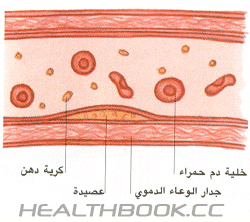 تصلب الشرايين 48e9b6e3e6