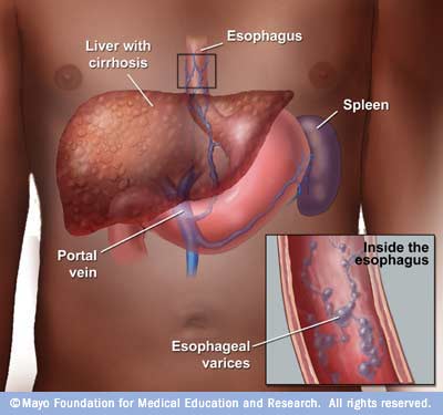 دوالي المريء Esophageal Varices  92b17a751c