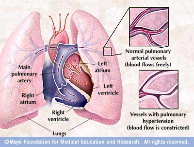 ارتفاع ضغط الدم الرئوي Pulmonary Hypertension 973c862ffc