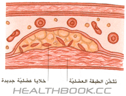 تصلب الشرايين 9f4012106f