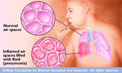 الالتهاب الرئوي – التهاب الرئة Pneumonia B1446be6f1