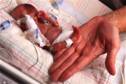 الطفل الخديج ، المبسترPremature birth B3cd2db1b3